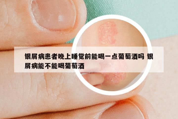 银屑病患者晚上睡觉前能喝一点葡萄酒吗 银屑病能不能喝葡萄酒