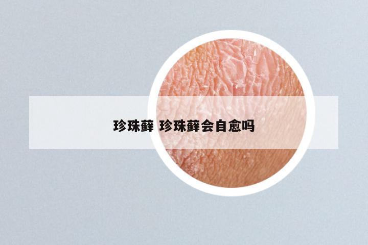 珍珠藓 珍珠藓会自愈吗