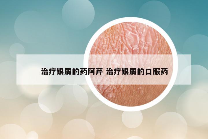 治疗银屑的药阿芹 治疗银屑的口服药