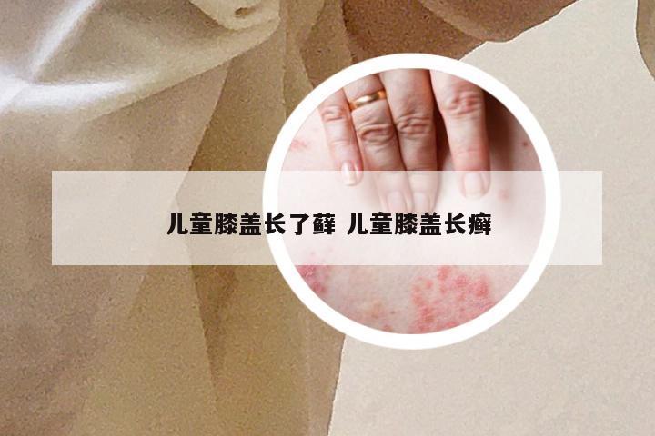 儿童膝盖长了藓 儿童膝盖长癣