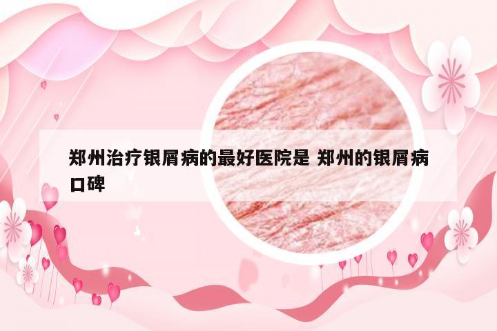 郑州治疗银屑病的最好医院是 郑州的银屑病口碑