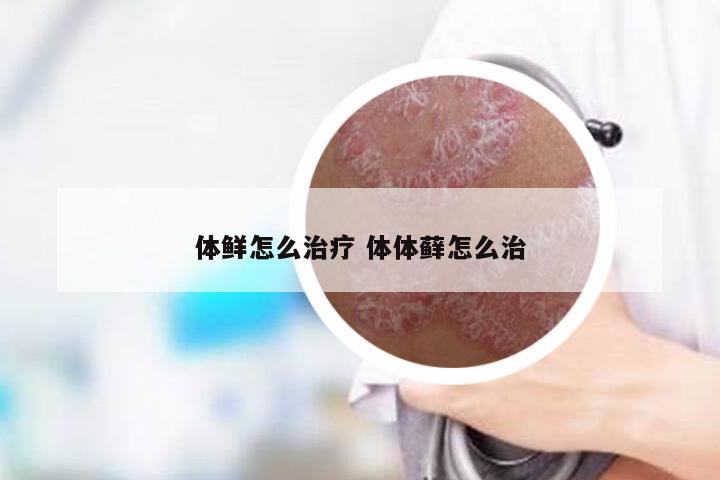 体鲜怎么治疗 体体藓怎么治