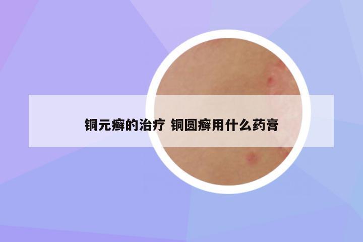 铜元癣的治疗 铜圆癣用什么药膏