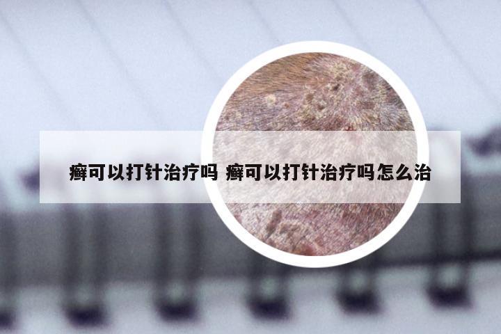 癣可以打针治疗吗 癣可以打针治疗吗怎么治