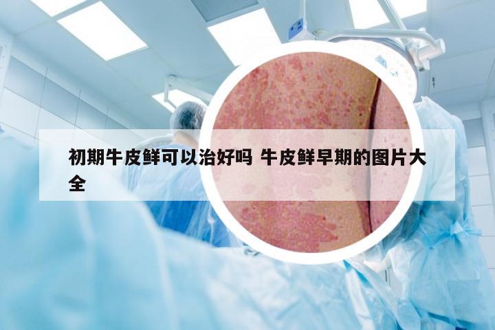 初期牛皮鲜可以治好吗 牛皮鲜早期的图片大全