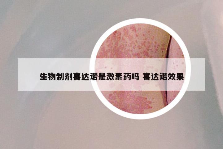 生物制剂喜达诺是激素药吗 喜达诺效果
