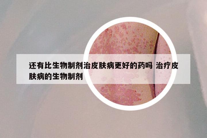 还有比生物制剂治皮肤病更好的药吗 治疗皮肤病的生物制剂
