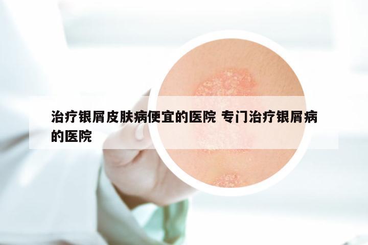 治疗银屑皮肤病便宜的医院 专门治疗银屑病的医院