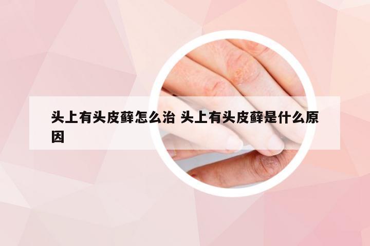 头上有头皮藓怎么治 头上有头皮藓是什么原因