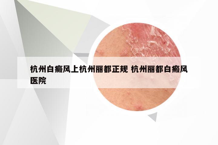 杭州白癜风上杭州丽都正规 杭州丽都白瘢风医院