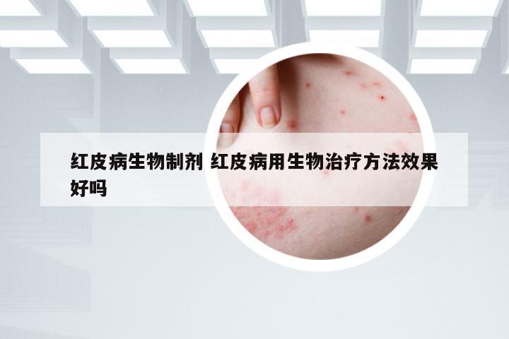 红皮病生物制剂 红皮病用生物治疗方法效果好吗