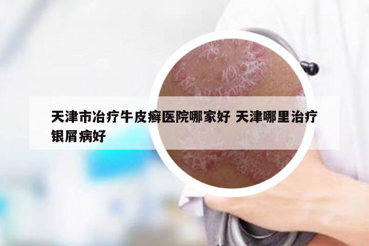 天津市冶疗牛皮癣医院哪家好 天津哪里治疗银屑病好