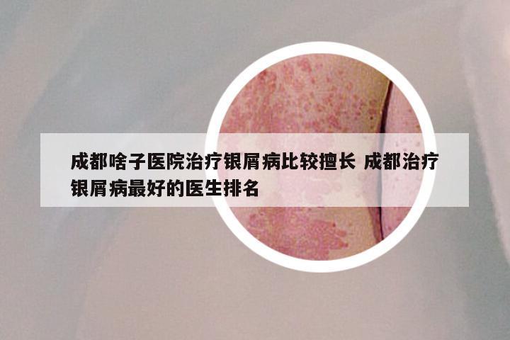 成都啥子医院治疗银屑病比较擅长 成都治疗银屑病最好的医生排名