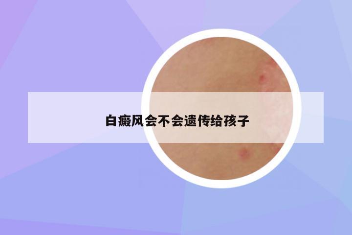 白癜风会不会遗传给孩子
