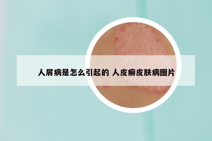 人屑病是怎么引起的 人皮癣皮肤病图片