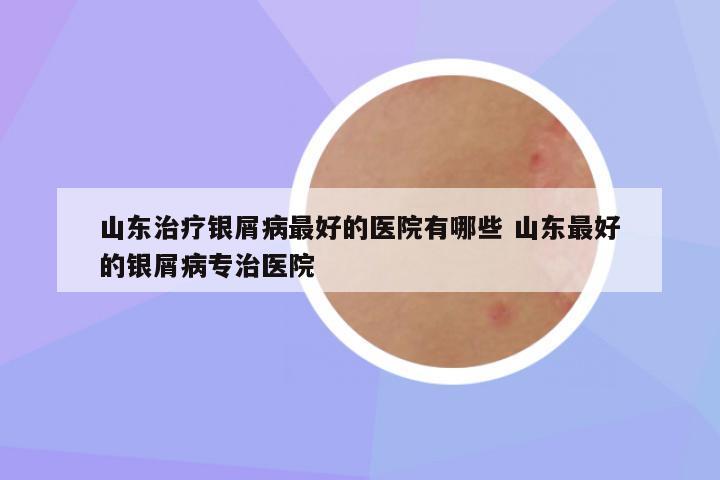 山东治疗银屑病最好的医院有哪些 山东最好的银屑病专治医院