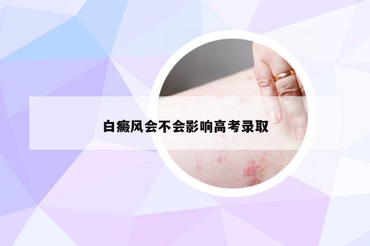 白癜风会不会影响高考录取