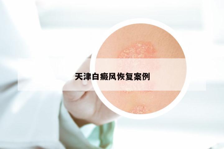 天津白癜风恢复案例