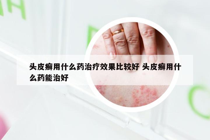 头皮癣用什么药治疗效果比较好 头皮癣用什么药能治好