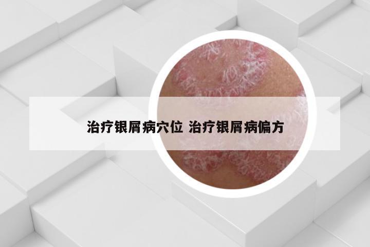 治疗银屑病穴位 治疗银屑病偏方