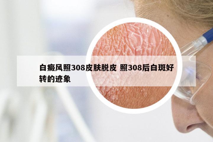 白癜风照308皮肤脱皮 照308后白斑好转的迹象