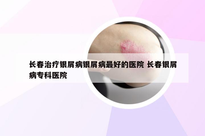 长春治疗银屑病银屑病最好的医院 长春银屑病专科医院
