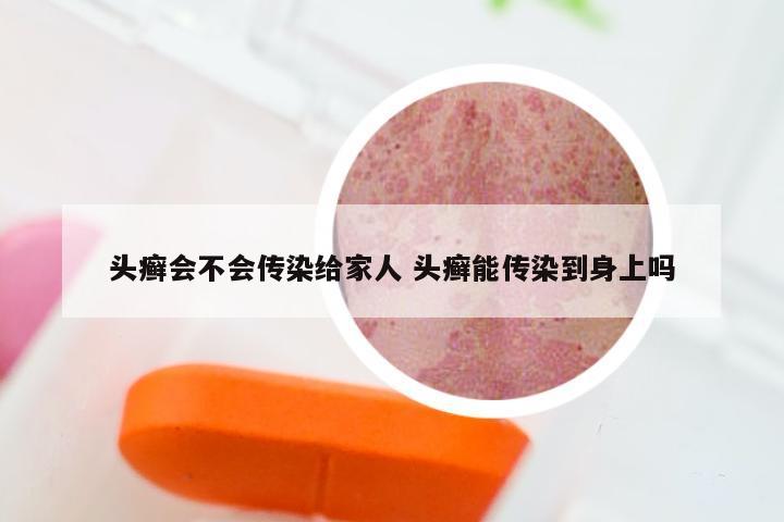 头癣会不会传染给家人 头癣能传染到身上吗