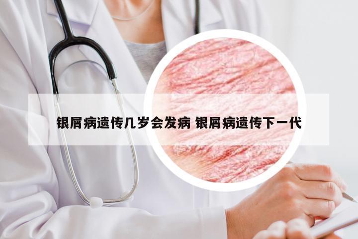 银屑病遗传几岁会发病 银屑病遗传下一代