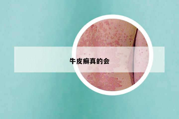 牛皮癣真的会