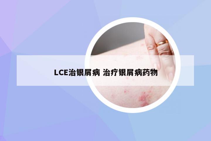 LCE治银屑病 治疗银屑病药物