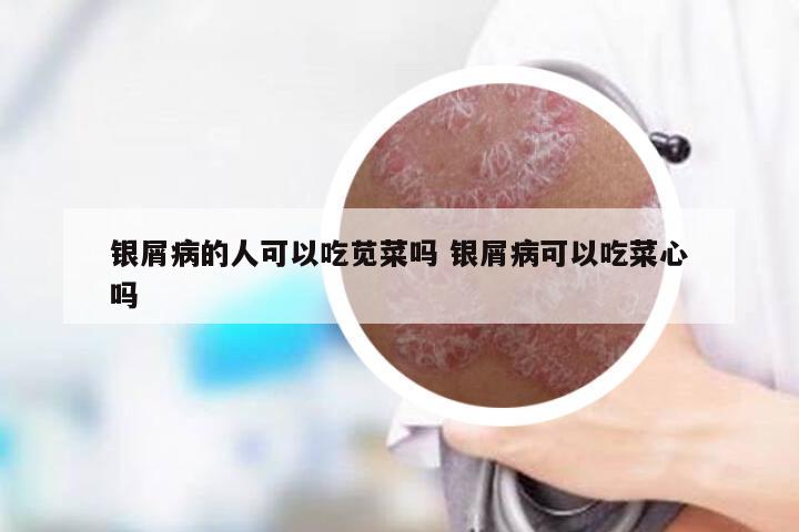 银屑病的人可以吃苋菜吗 银屑病可以吃菜心吗