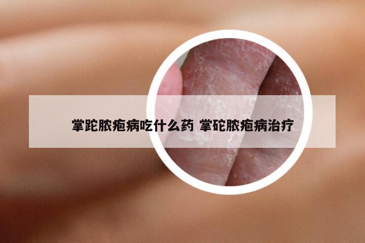 掌跎脓疱病吃什么药 掌砣脓疱病治疗