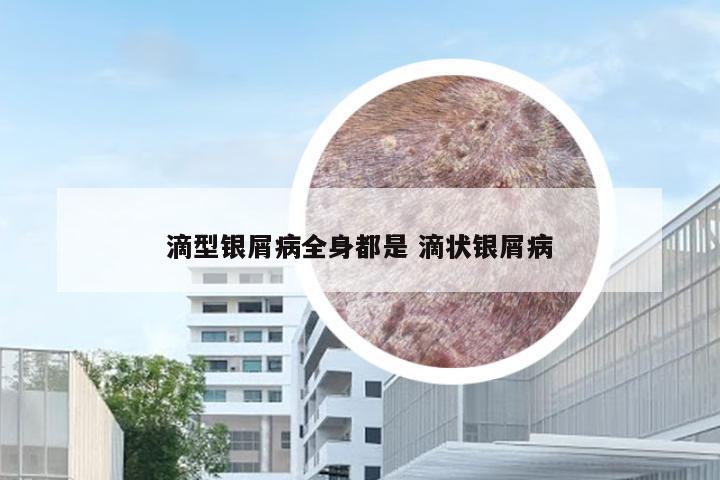 滴型银屑病全身都是 滴状银屑病