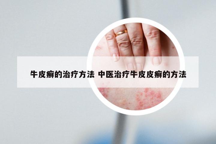 牛皮癣的治疗方法 中医治疗牛皮皮癣的方法