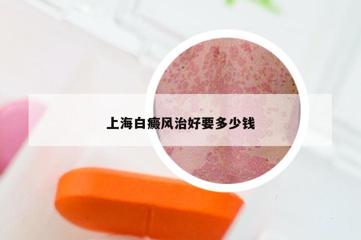 上海白癜风治好要多少钱