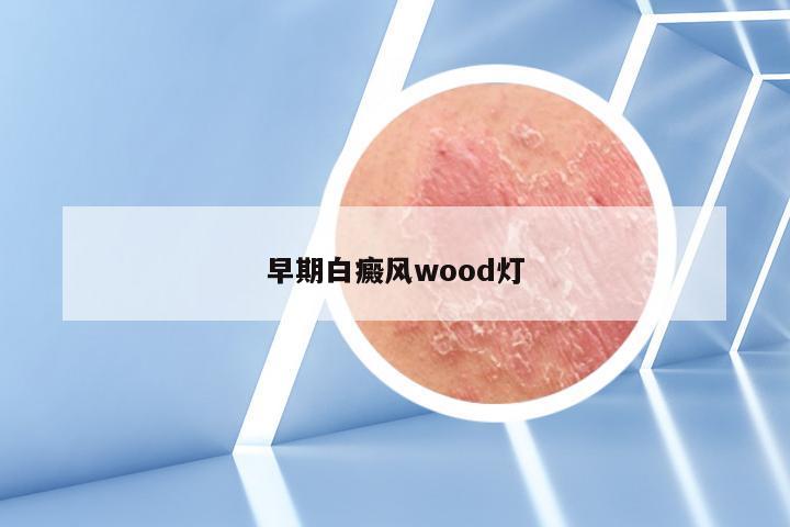 早期白癜风wood灯