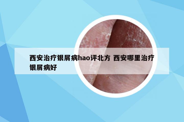 西安治疗银屑病hao评北方 西安哪里治疗银屑病好