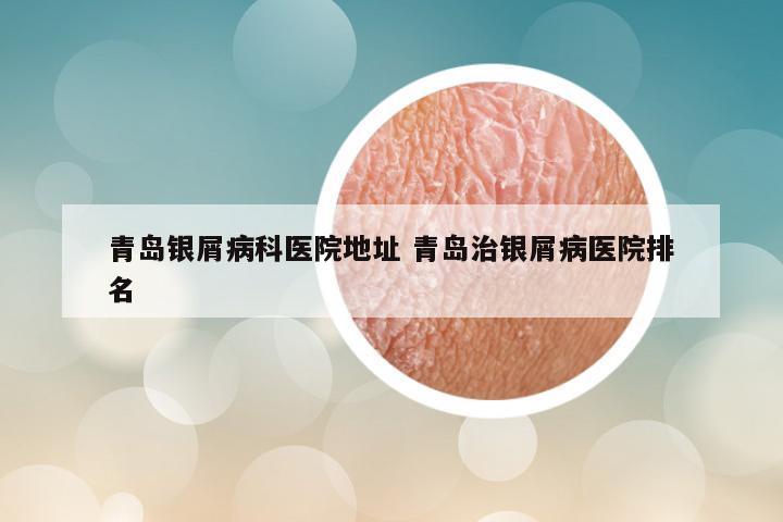 青岛银屑病科医院地址 青岛治银屑病医院排名
