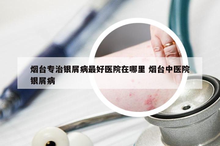 烟台专治银屑病最好医院在哪里 烟台中医院银屑病