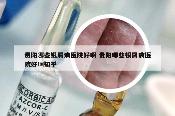 贵阳哪些银屑病医院好啊 贵阳哪些银屑病医院好啊知乎