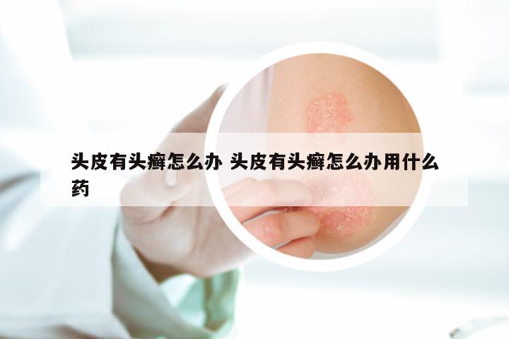 头皮有头癣怎么办 头皮有头癣怎么办用什么药