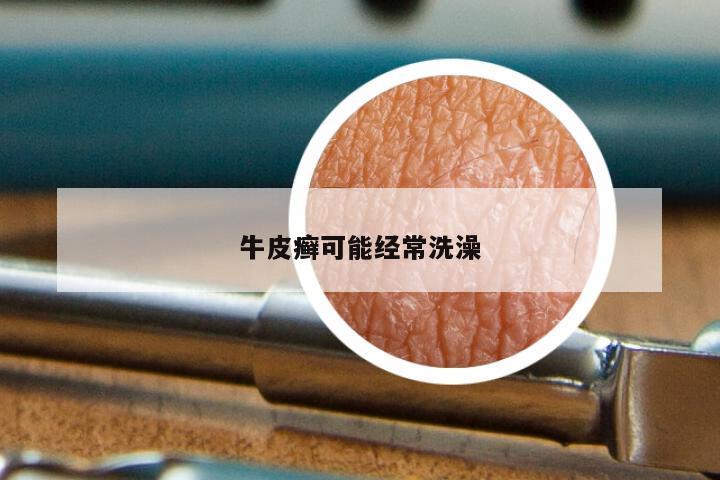牛皮癣可能经常洗澡