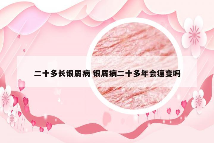 二十多长银屑病 银屑病二十多年会癌变吗