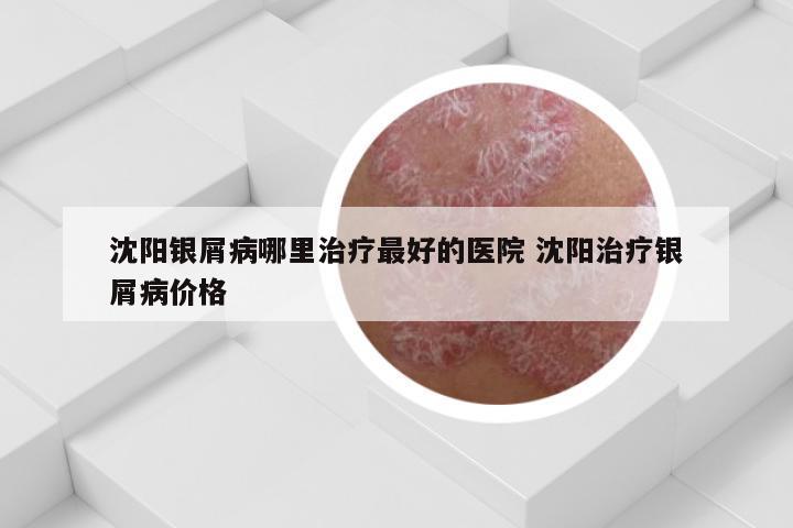 沈阳银屑病哪里治疗最好的医院 沈阳治疗银屑病价格