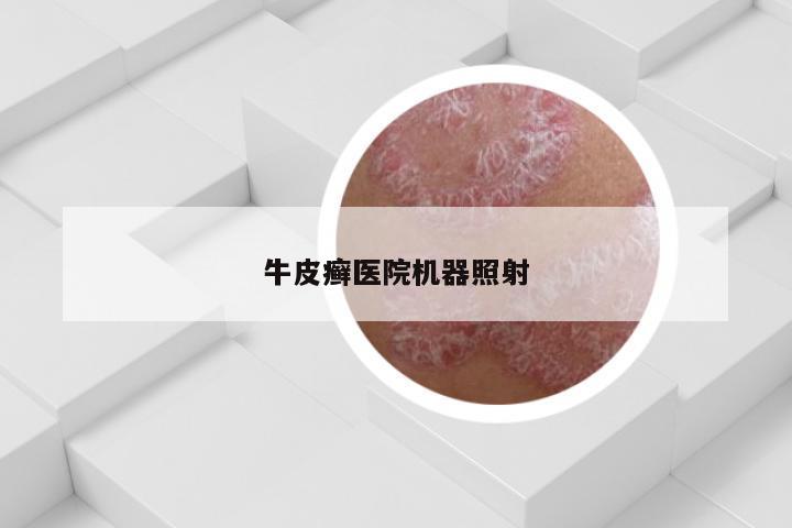 牛皮癣医院机器照射
