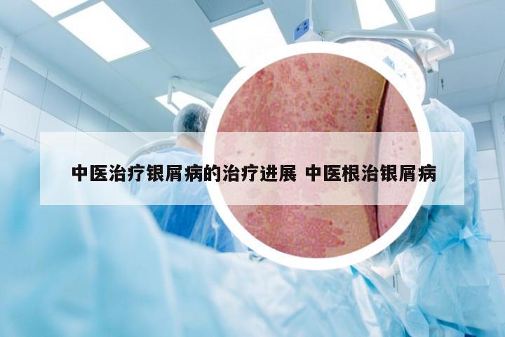 中医治疗银屑病的治疗进展 中医根治银屑病