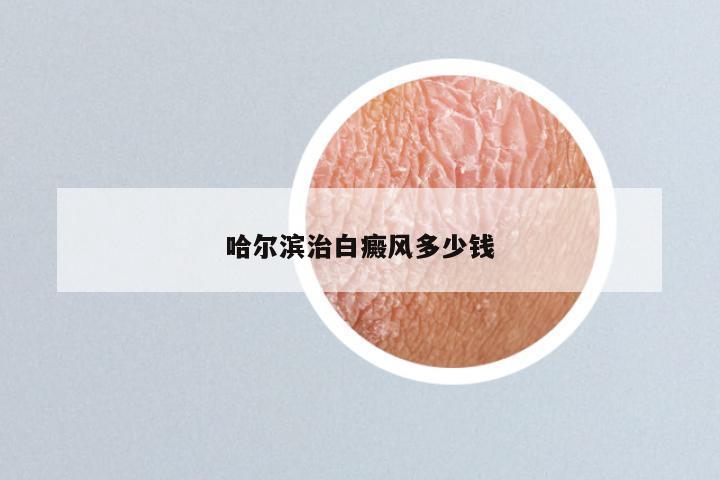 哈尔滨治白癜风多少钱