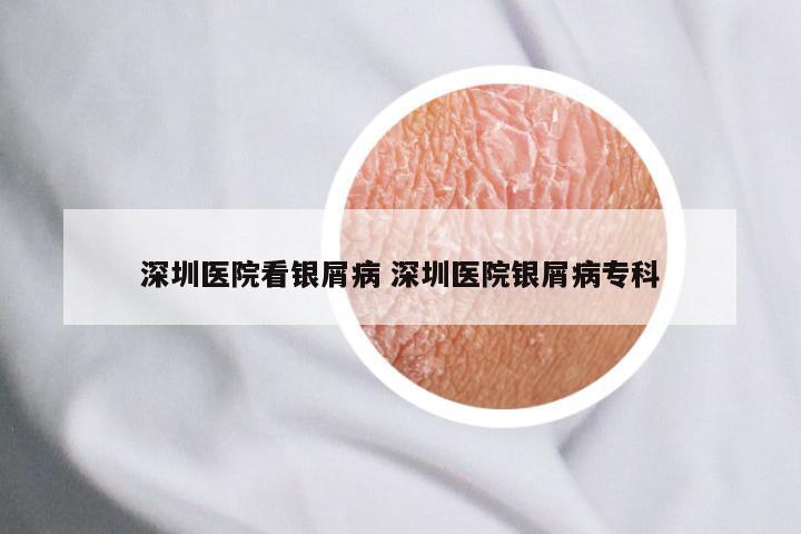 深圳医院看银屑病 深圳医院银屑病专科