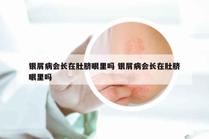 银屑病会长在肚脐眼里吗 银屑病会长在肚脐眼里吗