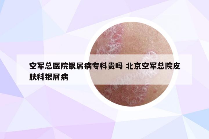 空军总医院银屑病专科贵吗 北京空军总院皮肤科银屑病